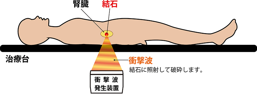 結石破砕装置