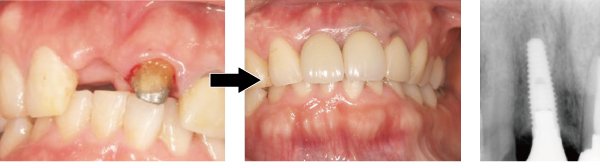骨増生併用インプラント治療