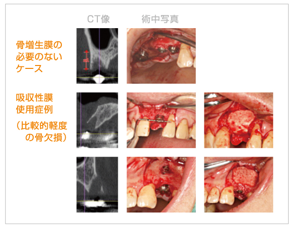 当院で行っている骨増生術（一部紹介）