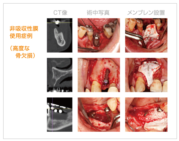 当院で行っている骨増生術（一部紹介）